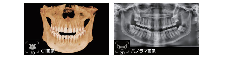 邑楽郡　福田歯科医院　CTレントゲン説明