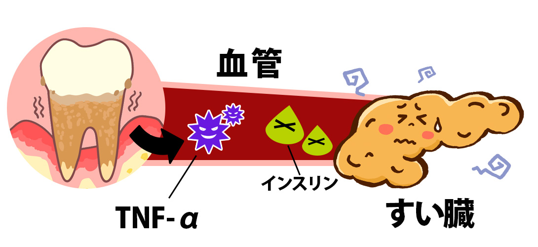 歯周病とすい臓